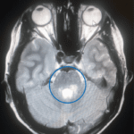 Brain MRI scan showing highlighted abnormal area
